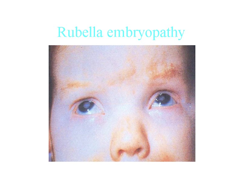 Rubella embryopathy Rubella embryopathy
